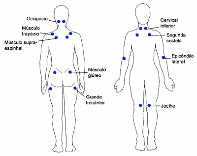 pontos de dor da fibromialgia